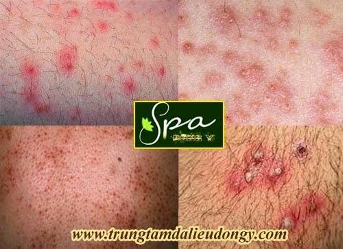 TRUNG TÂM DA LIỄU SPA ĐÔNG Y VIỆT NAM TRUNG TÂM DA LIỄU SPA ĐÔNG Y VIỆT NAM