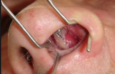 Các dị tật bẩm sinh đường thở như polyp mũi có thể dẫn đến nhiều bệnh hô hấp, trong đó có viêm mũi dị ứng