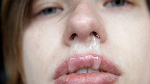 Chảy dịch mũi là triệu chứng khởi phát viêm xoang và một số bệnh viêm mũi, cảm cúm
