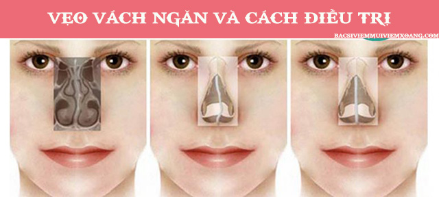 Vẹo vách ngăn mũi và cách điều trị - vẹo vách ngăn mũi trái - lệch vách ngăn mũi bên phải Vẹo vách ngăn mũi - vẹo vách ngăn mũi tiếng anh - lệch vách ngăn mũi bên trái