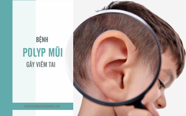 Bệnh Polyp mũi gây viêm tai nếu người bệnh không điều trị sớm Bệnh polyp mũi co nguy hiểm không?