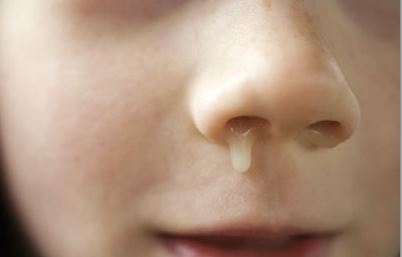 Chảy nước mũi là một triệu chứng của bệnh