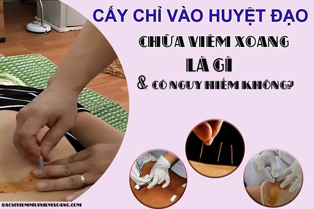 Cấy chỉ chữa bệnh viêm xoang