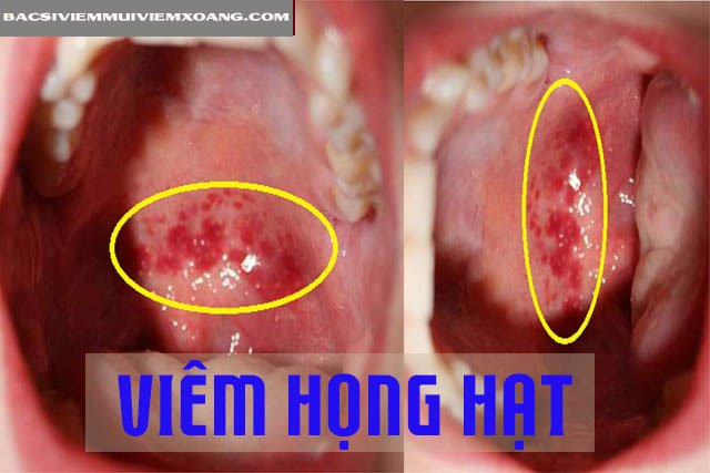 Bệnh viêm họng hạt có lây nhiễm không?