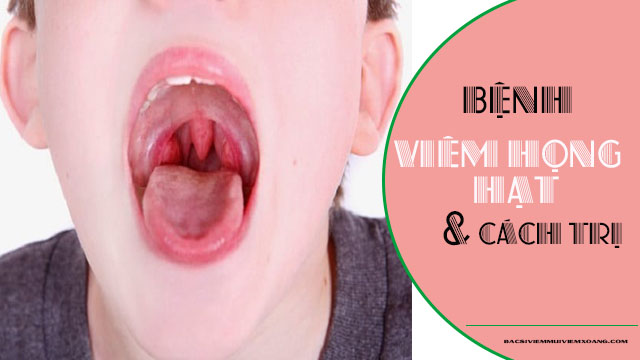 Viêm họng hạt ở trẻ em và cách chữa trị Viêm họng hạt ở trẻ em