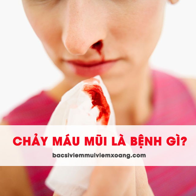 Chảy máu mũi là biểu hiện của bệnh gì? - chảy máu mũi nhiều là bệnh gì - tự nhiên bị chảy máu mũi là bệnh gì - triệu chứng chảy máu mũi là bệnh gì Chảy máu mũi là biểu hiện của bệnh gì? chảy máu mũi bên trái là bệnh gì - chảy máu mũi là hiện tượng gì - chảy máu mũi là triệu chứng bệnh gì