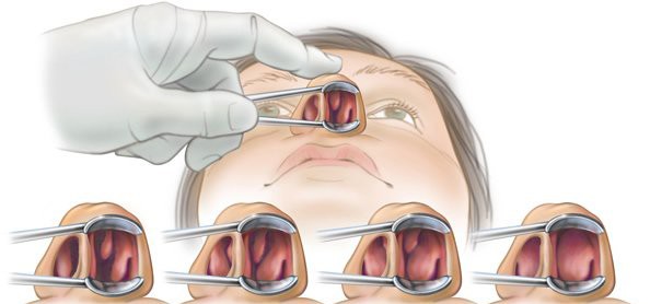 Cấu trúc bất thường vùng mũi, xoang ảnh hưởng đến dẫn lưu dịch tiết xoang, gây viêm xoang cấp và mãn tính