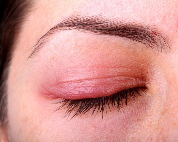 Một bệnh nhân gặp biến chứng ở mí mắt do viêm xoang cấp