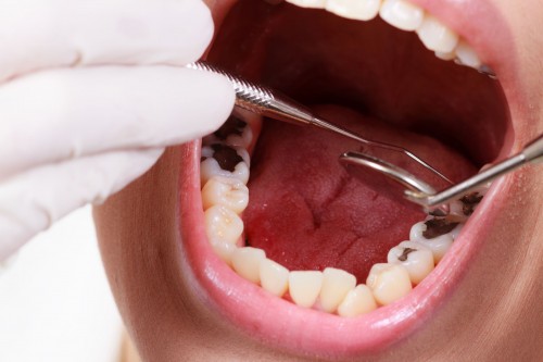 Vì sao sâu răng lại gây viêm xoang?