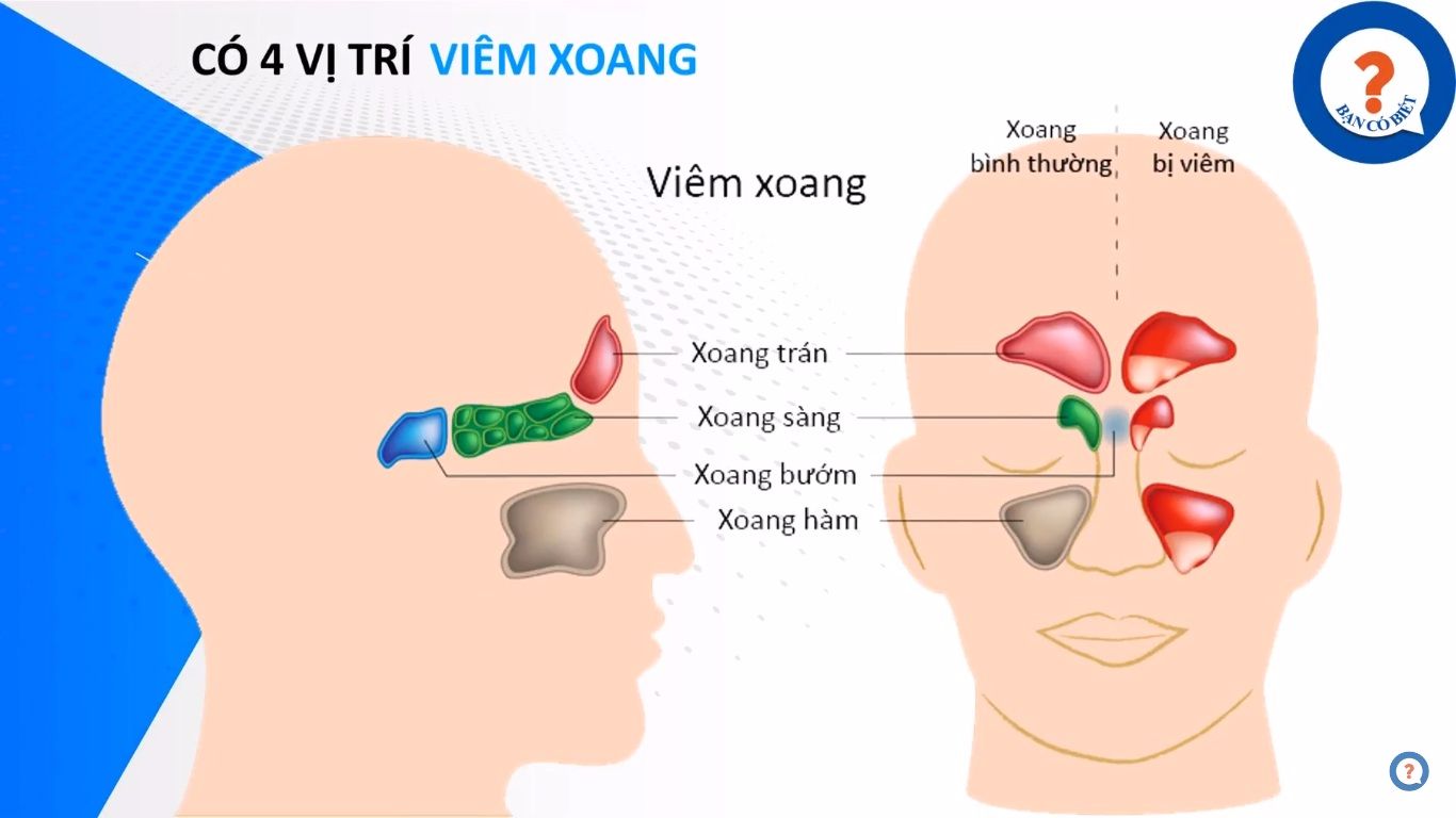 Có 4 dạng viêm xoang tương ứng với 4 vị trí của xoang dạng viêm xoang, Chua viem xoang, Dieu tri viem xoang, Viem xoang, Benh viem xoang