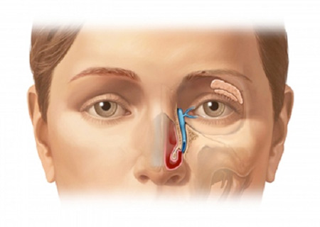 Viêm xoang mãn tính có thể gây ra nhiều biến chứng ở mắt, hệ hô hấp, tĩnh mạch, não,...