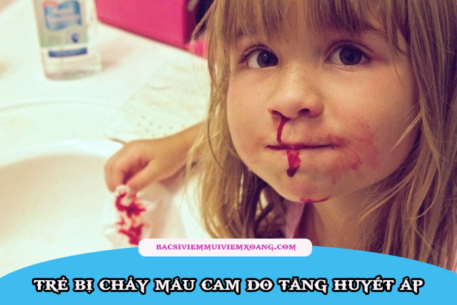 Trẻ hay chảy máu cam là bệnh gì?