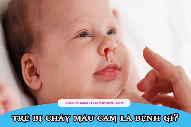 Trẻ hay chảy máu cam là bệnh gì?