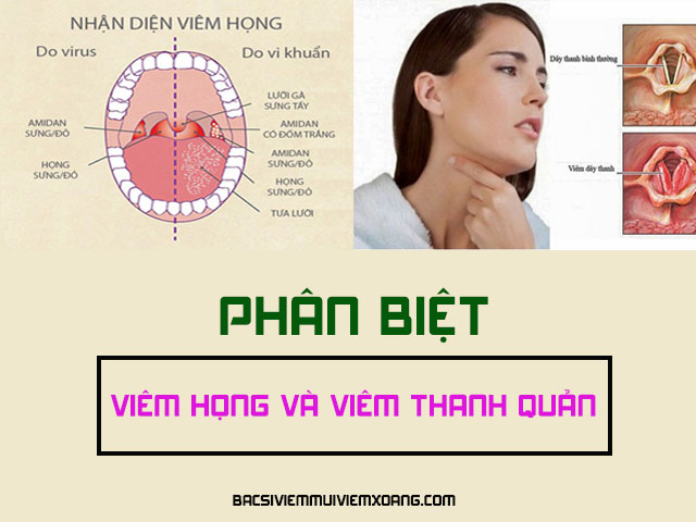 Viêm họng và viêm thanh quản