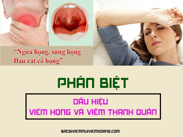 Dấu hiệu viêm họng viêm thanh quản