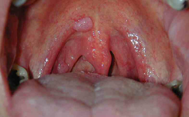 hình ảnh ung thư vòm họng giai đoạn 1