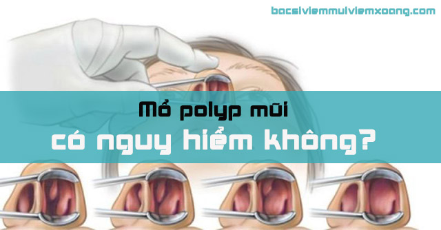 Mổ polyp mũi có nguy hiểm không? Mổ polyp mũi có nguy hiểm không?