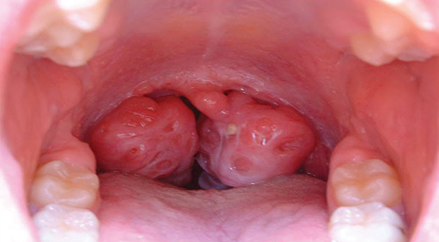 Tìm hiểu 8 triệu chứng của bệnh viêm họng hạt