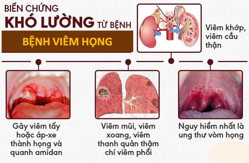 Một số biến chứng nghiêm trọng của bệnh viêm họng Một số biến chứng nghiêm trọng của bệnh viêm họng