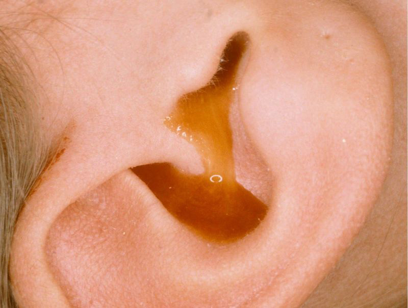 Viêm amidan biến chứng viêm tai giữa
