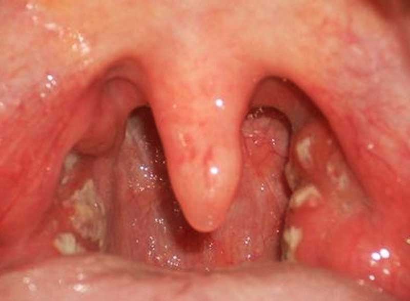 Hình ảnh bệnh viêm amidan Hình ảnh bệnh viêm amidan