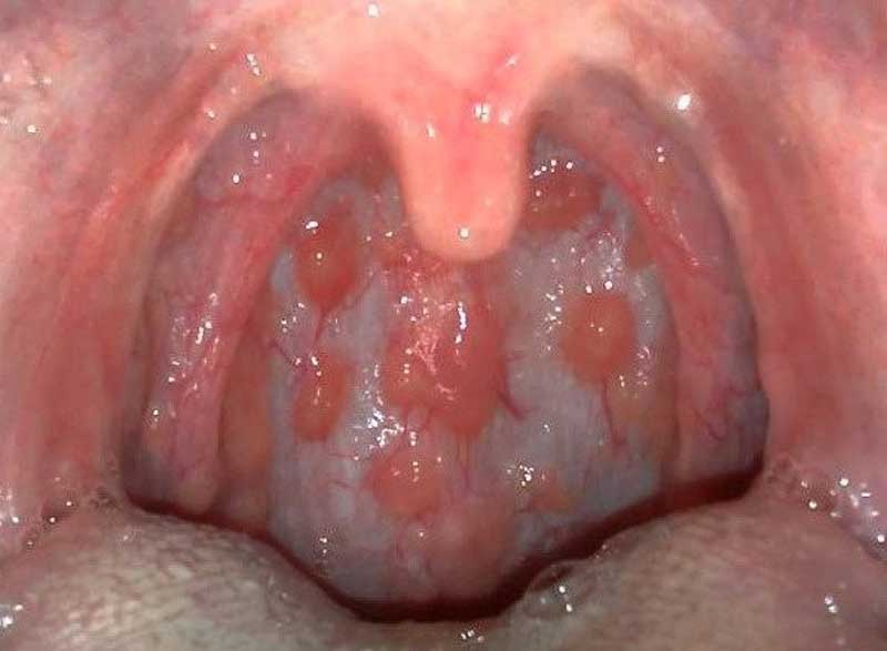 Viêm họng hạt có lây lan không? Viêm họng hạt có lây lan không?