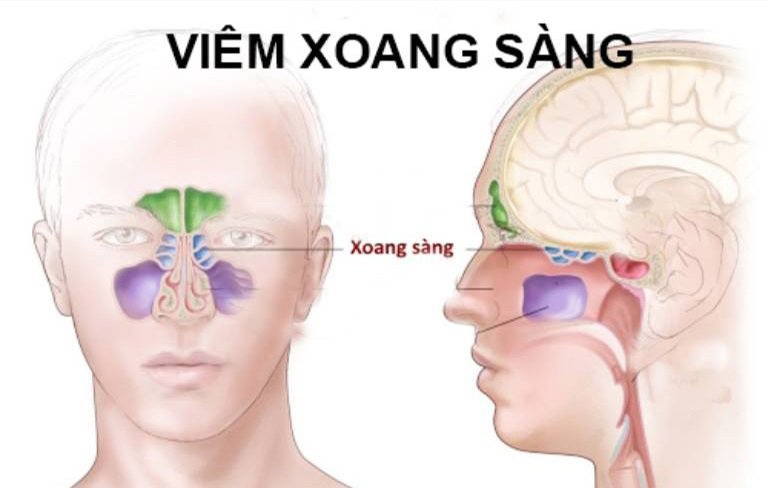 Viêm xoang sàng dễ gây nhiều biến chứng Viêm xoang sàng dễ gây nhiều biến chứng