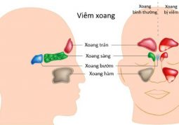 Hệ thống xoang tiếp giáp với nhiều cơ quan dễ gây biến chứng