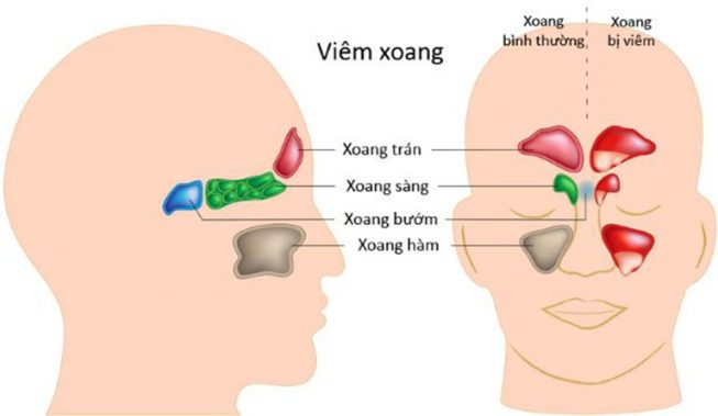 Hệ thống xoang tiếp giáp với nhiều cơ quan dễ gây biến chứng